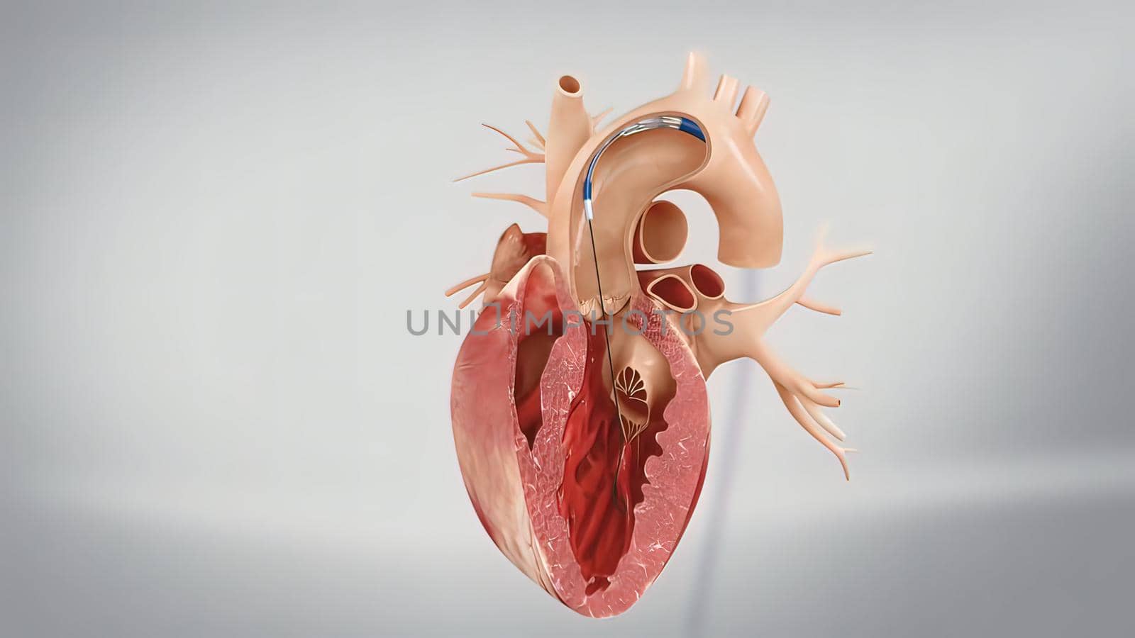 Coronary angioplasty is a procedure used to widen blocked or narrowed coronary arteries the main blood vessels supplying the heart. 3D illustration