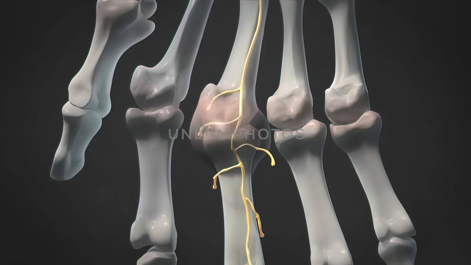 Swollen and inflamed knuckles, a condition that causes joint inflammation from a joint infection.3D illustration