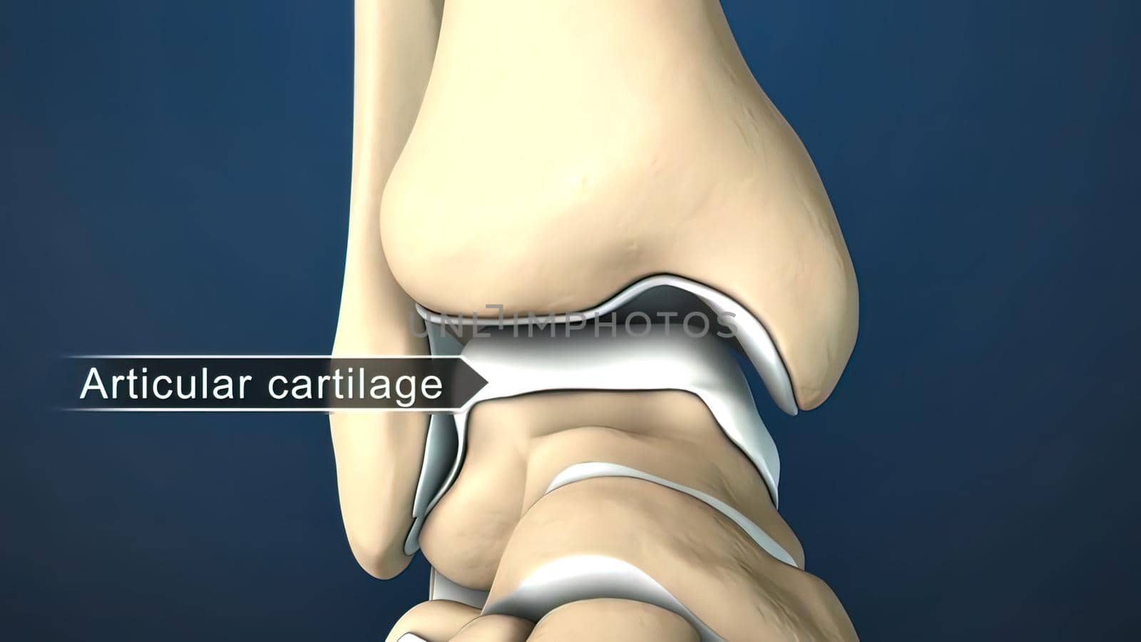 injury to the ankle and stretching 3D illustration