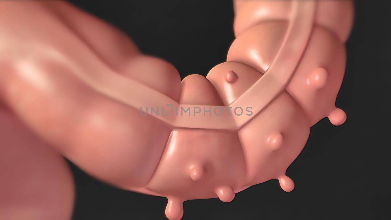 ulcerative colitis, an inflammatory bowel disease that causes inflammation by creativepic