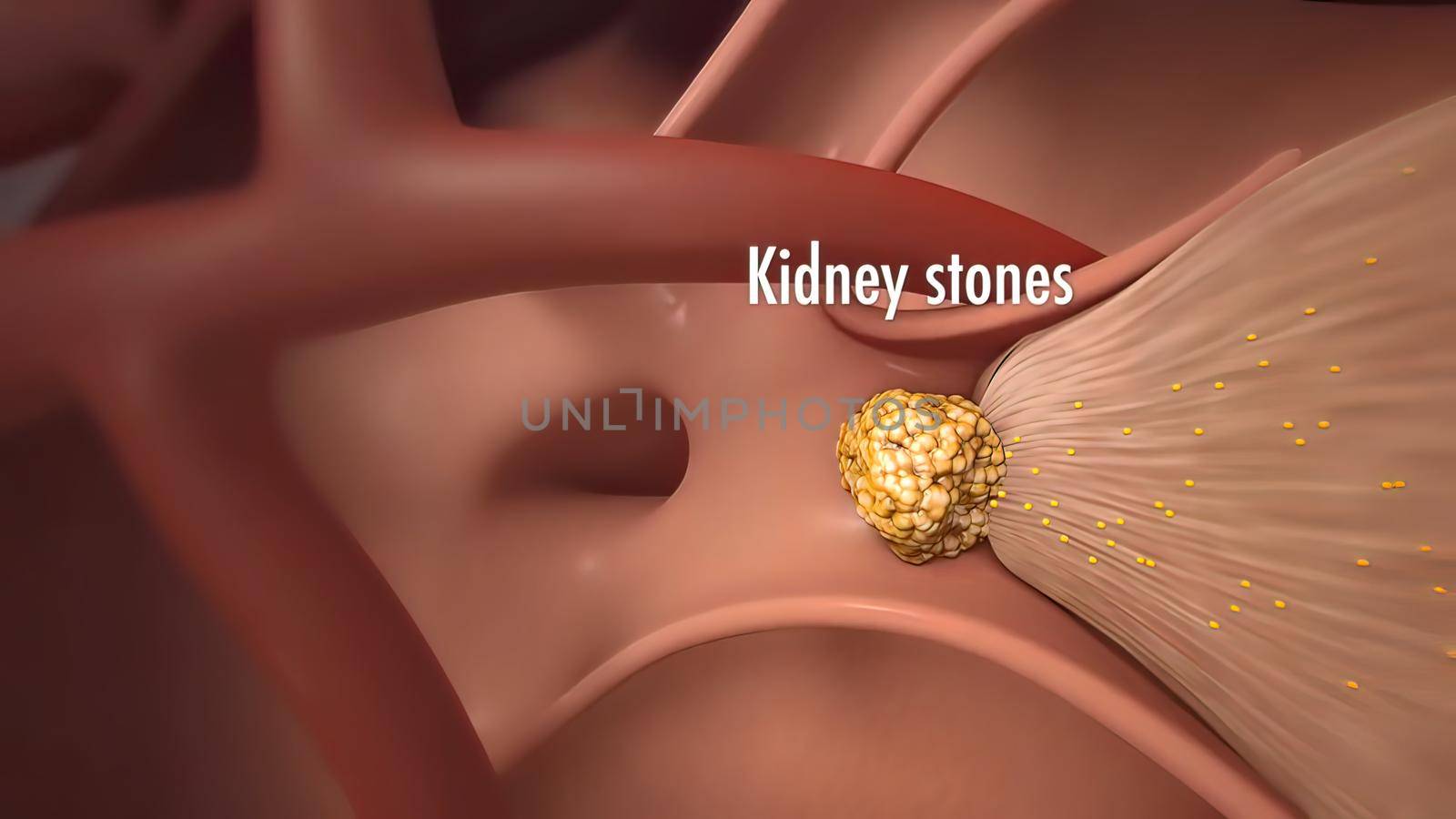 Kidney stones are small pebbles of salt and mineral in the urine. 3Dillustration