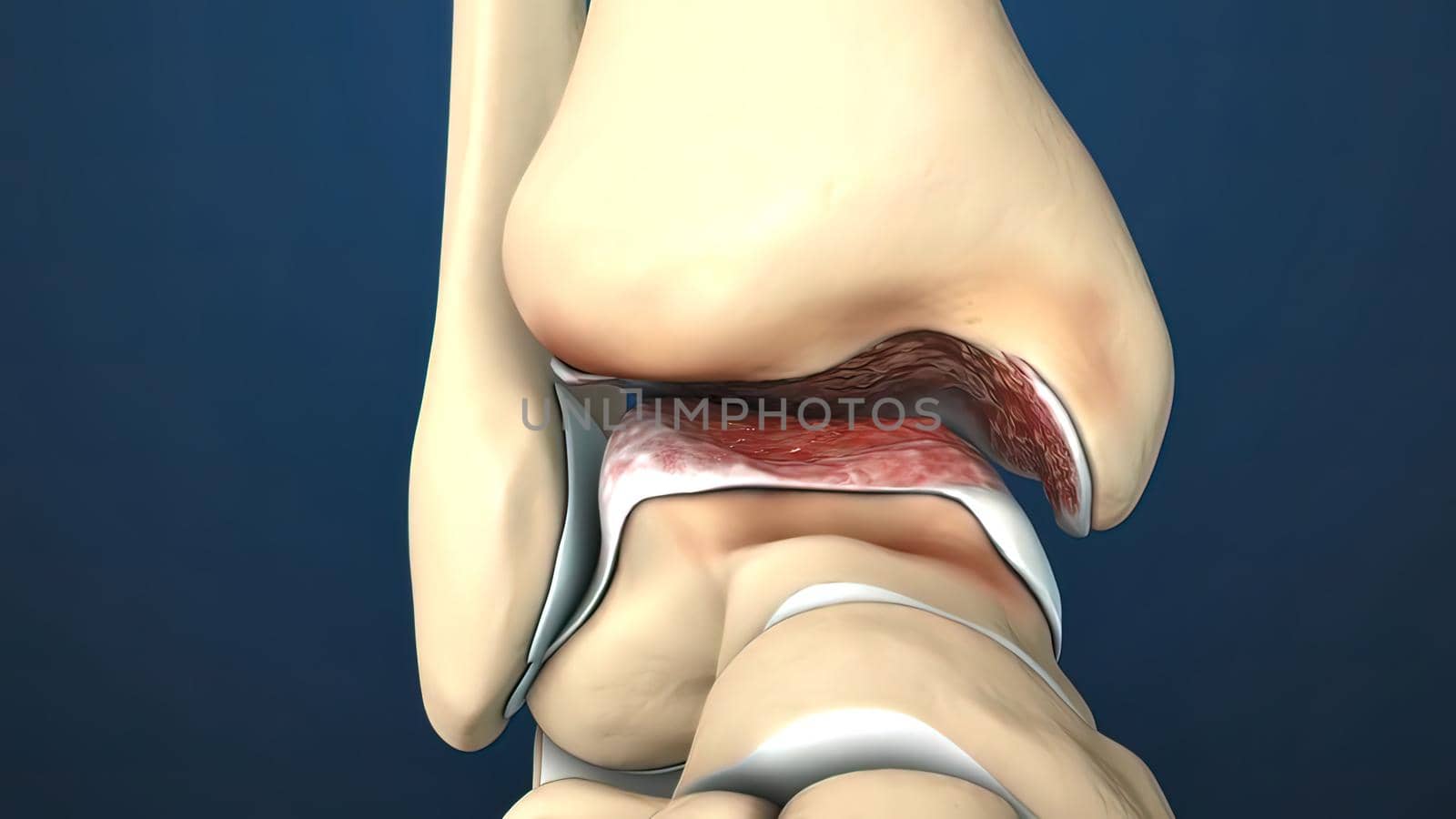 injury to the ankle and stretching 3D illustration