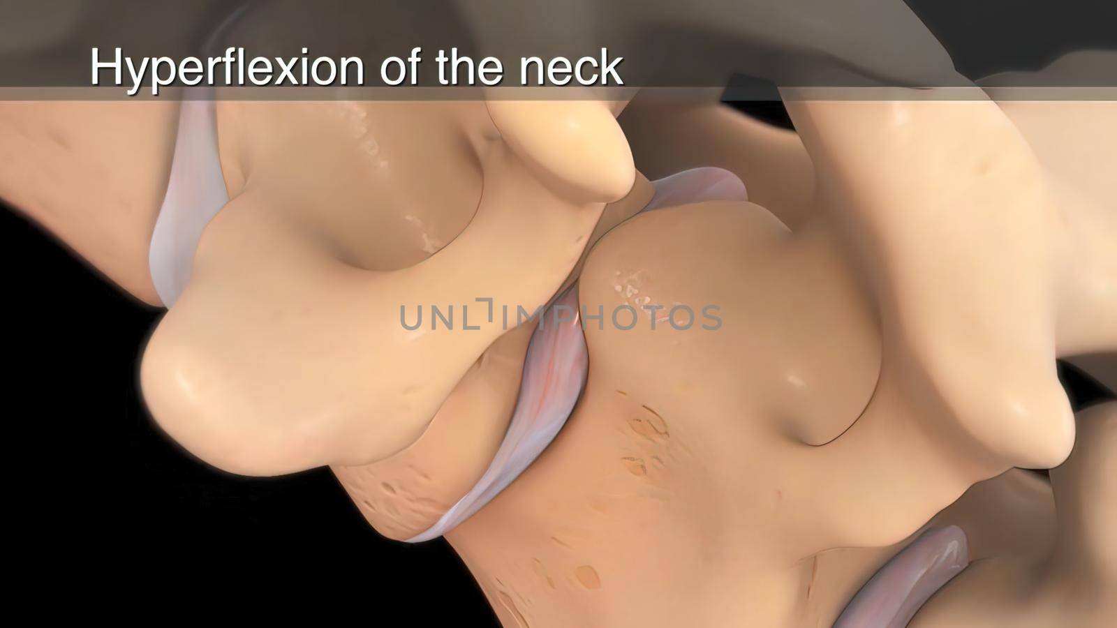 hyperflexion of the neck 3d illustration