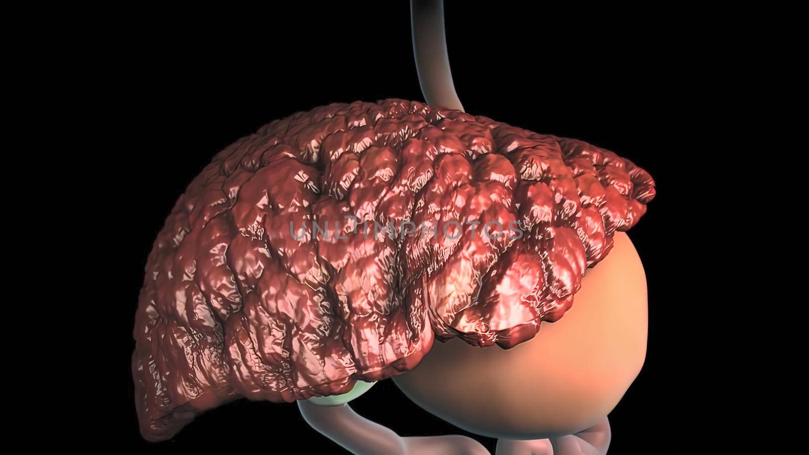 Various types of cancer can occur in the liver. The most common type of liver cancer is hepatocellular carcinoma, which starts in the main type 3D illustration