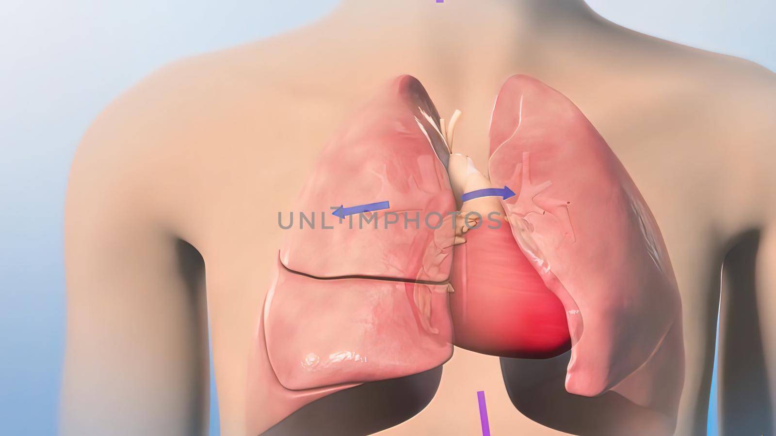 The Cardiovascular system. Hypoplastic left heart syndrome 3D illustration