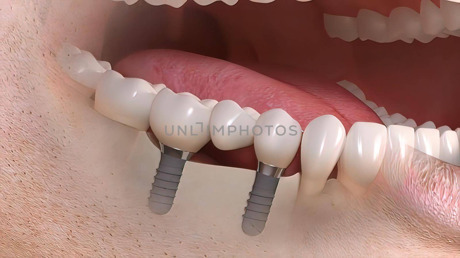 Dental implant surgery. A dental implant is a metal post that replaces the root portion of a missing tooth. 3D illustration