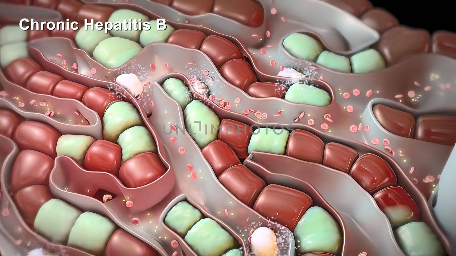 Irritation and swelling of the liver from infection with the hepatitis B virus 3D illustration