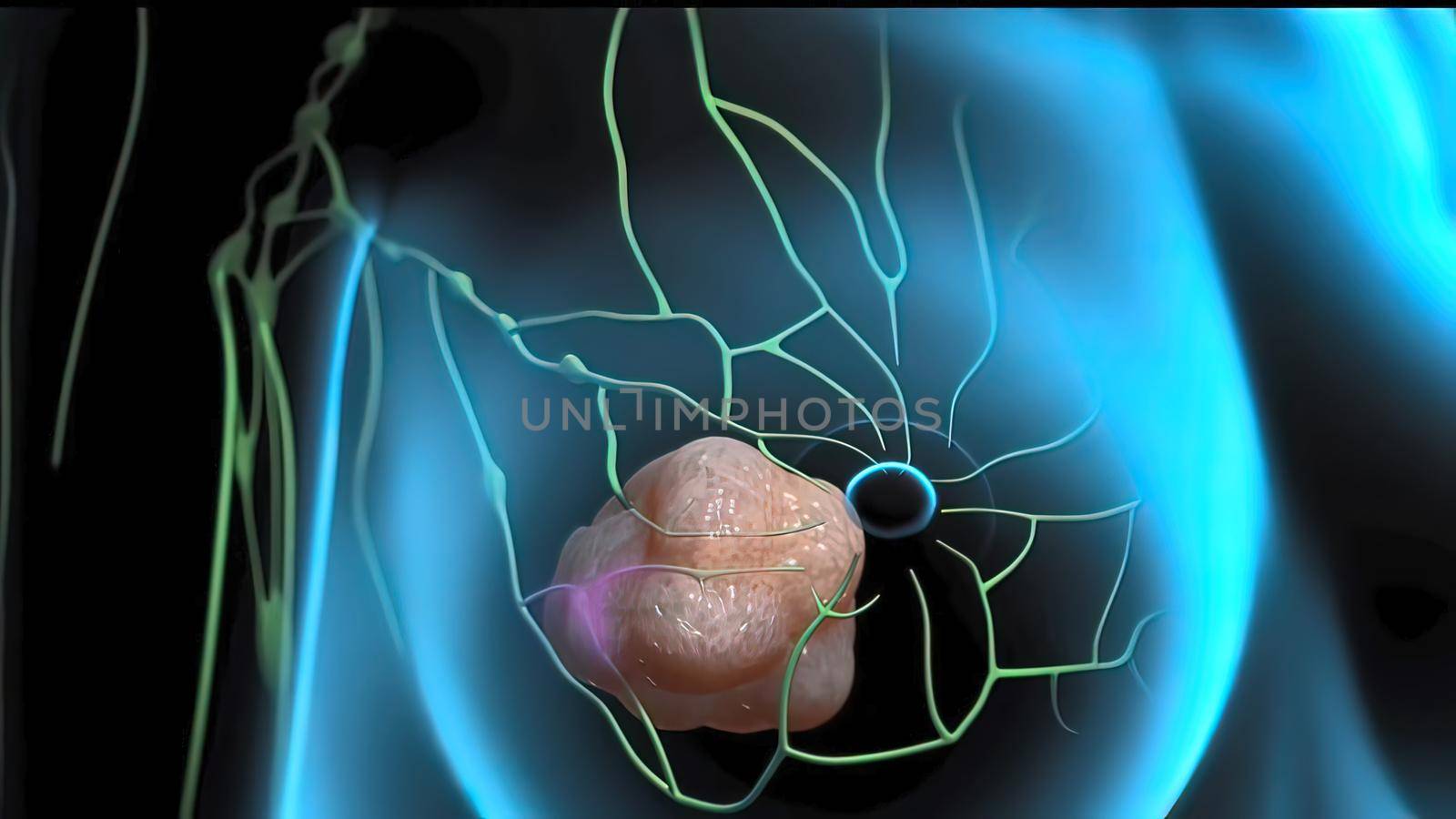 Lymphatic vessels can promote the process of metastasis by providing a pathway for cancer cells to emerge from a tumor and reach nearby structures called lymph nodes. 3D illustration