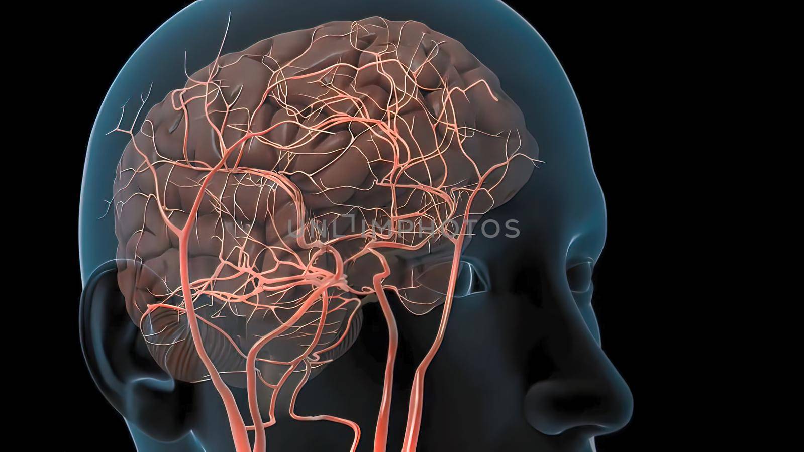 Atherosclerosis, . Atherosclerosis is the narrowing of arteries due to the formation of plaques in their walls. 3D illustration