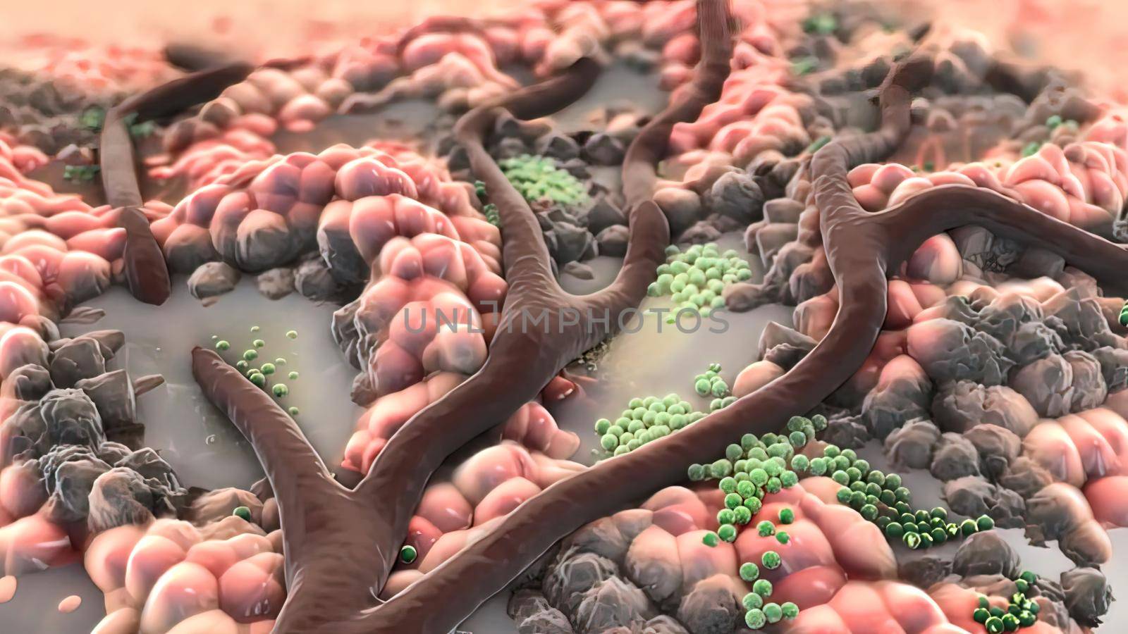 Animatied of infected wound ,bacteria , pus, abscess by creativepic