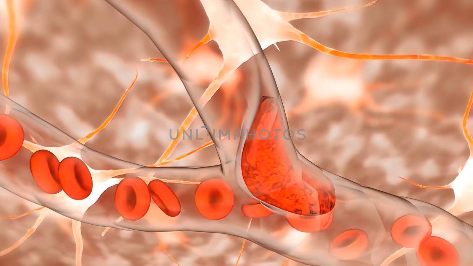 ischaemia is a restriction in blood supply to any tissues, muscle group, or organ of the body, causing a shortage of oxygen that is needed for cellular metabolism 3D illustration