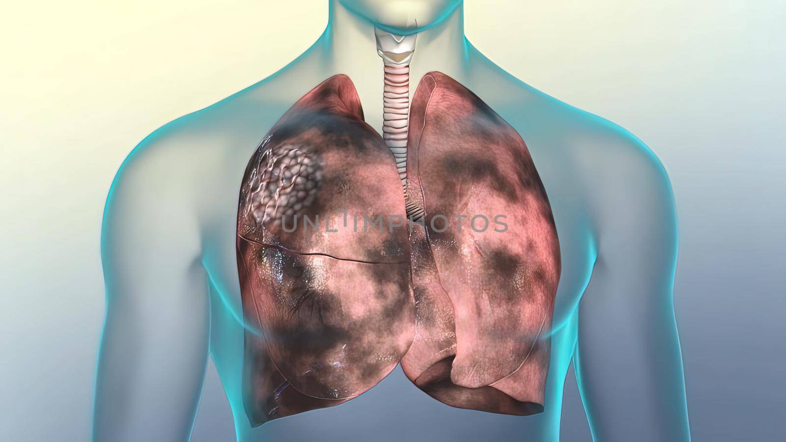 Smoking can cause lung disease by damaging your airways and the small air sacs found in your lungs. 3D illustration