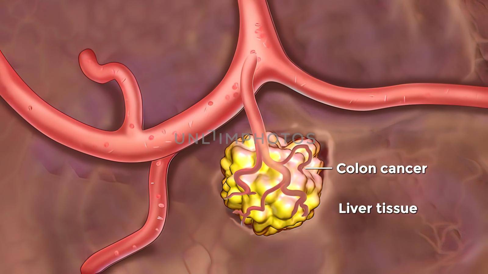 Metastasis for cancer that spreads to a different part of the body from where it started. 3D illustration