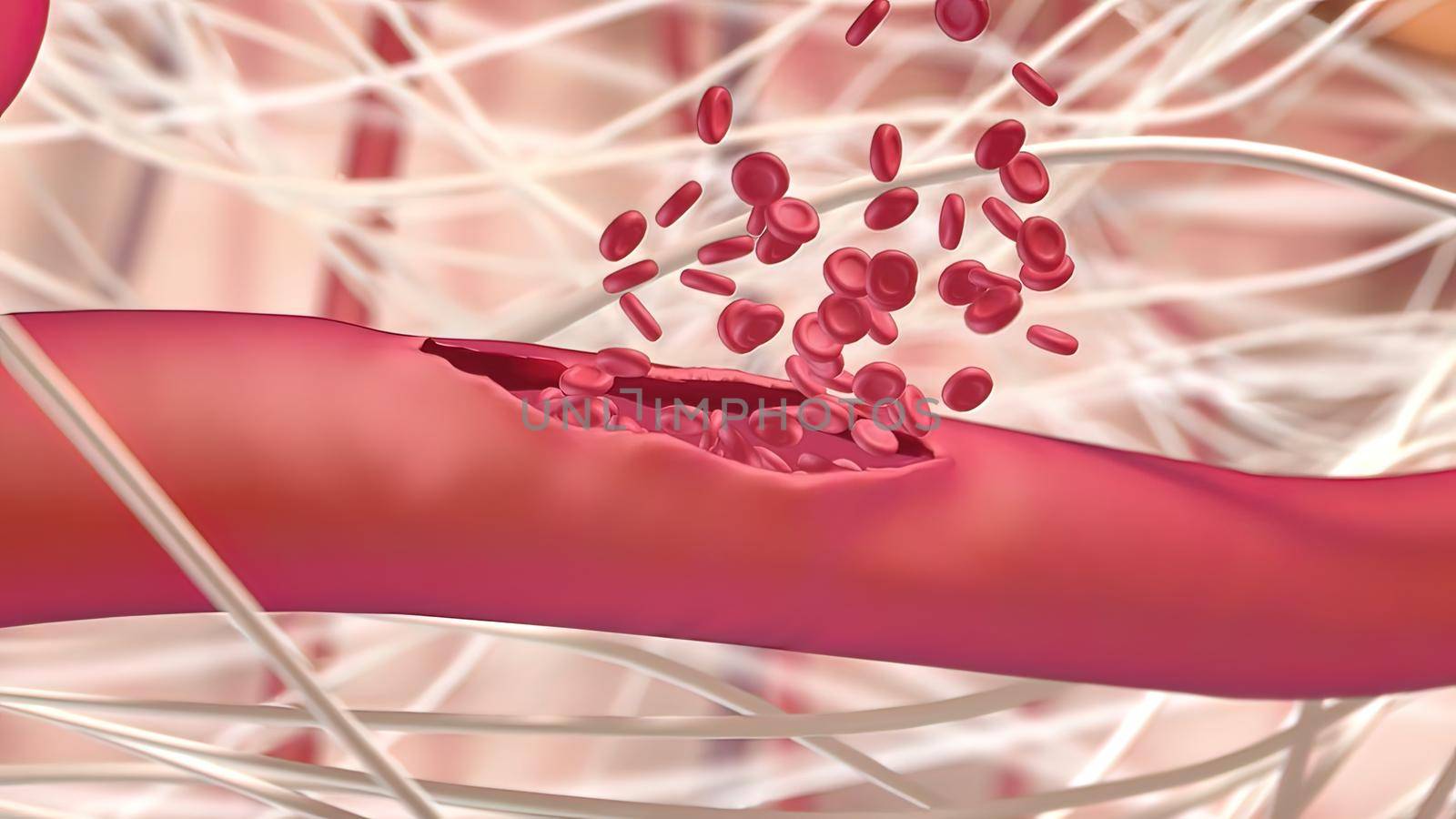 Internal bleeding is one of the most serious consequences of trauma. 3D illustration