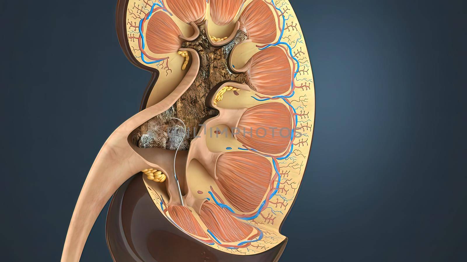 Lithotripsy treats kidney stones by sending focused ultrasonic energy or shock waves directly to the stone first located with fluoroscopy 3D illustration