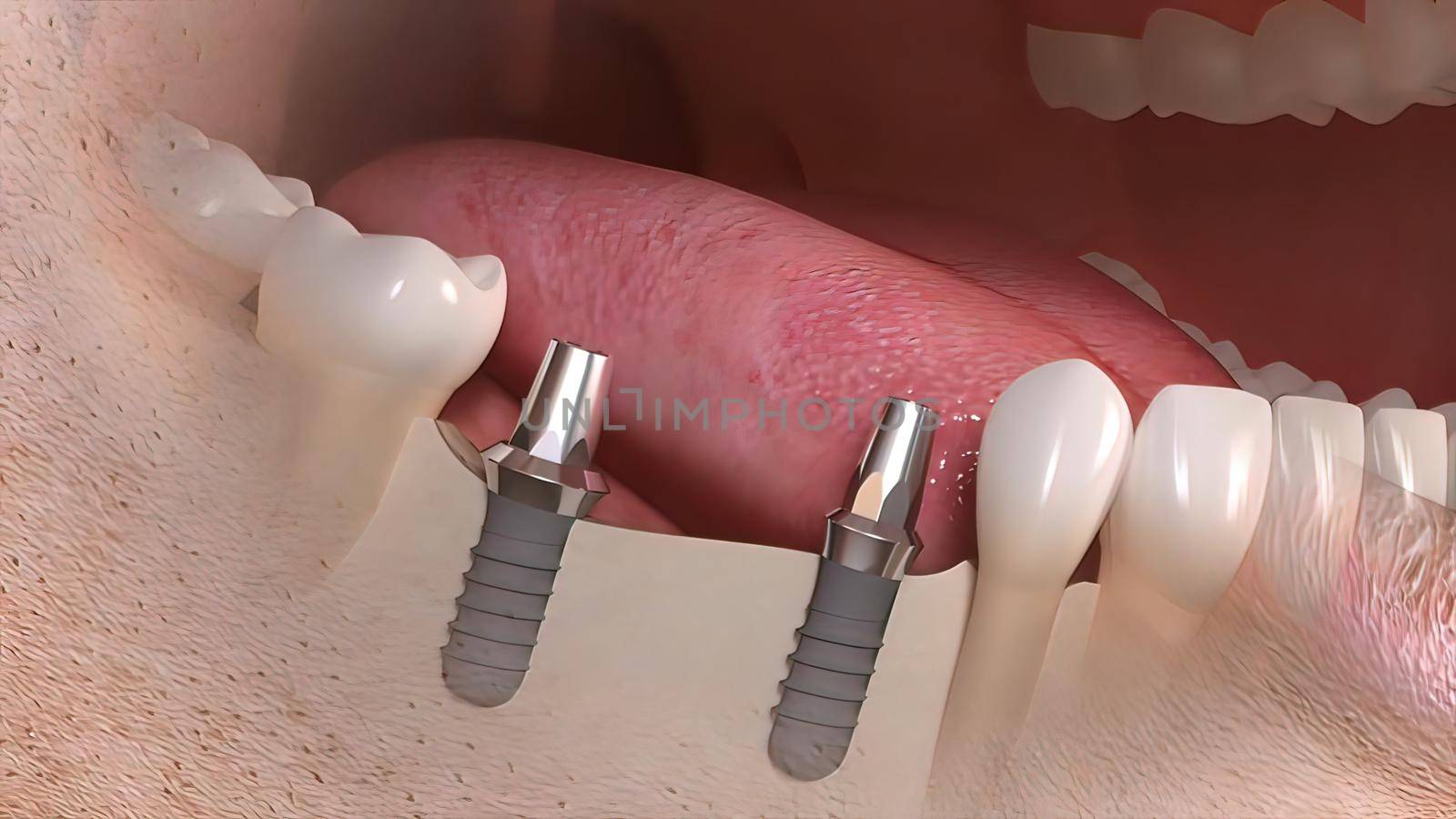 Dental implant surgery. by creativepic