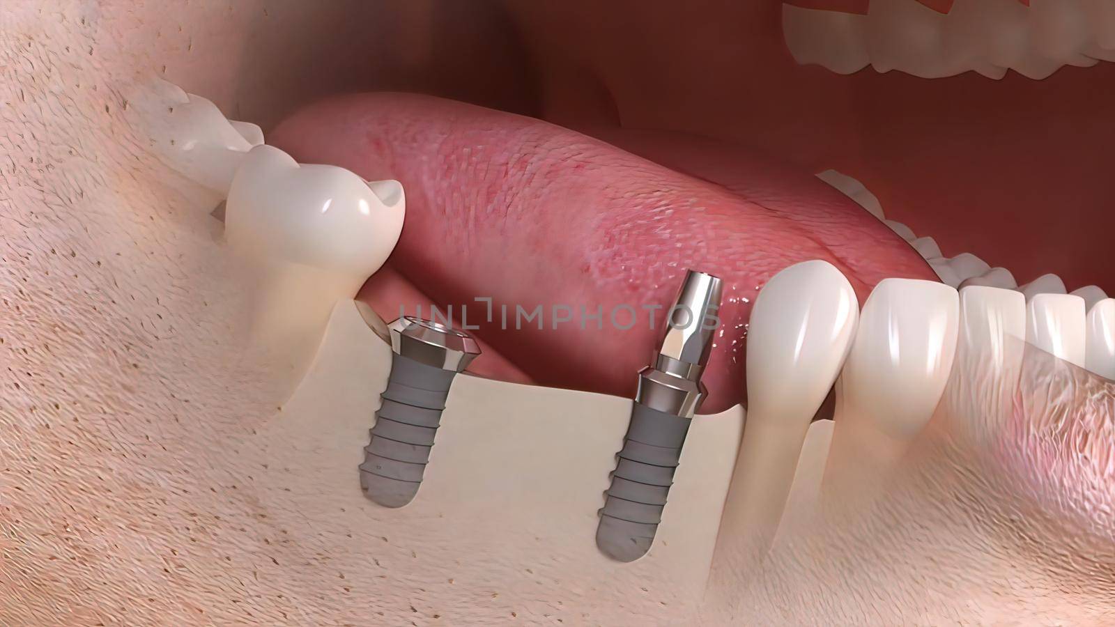 Dental implant surgery. A dental implant is a metal post that replaces the root portion of a missing tooth. 3D illustration