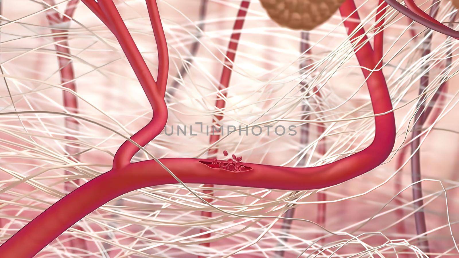 Internal bleeding is one of the most serious consequences of trauma. 3D illustration