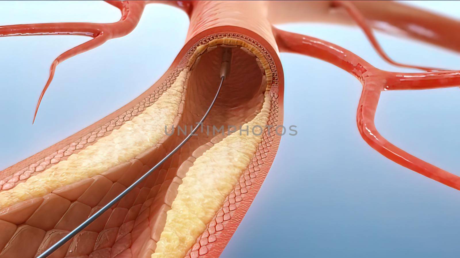 Angioplasty and Vascular Stenting, inserting a stent into vascular access 3D illustration