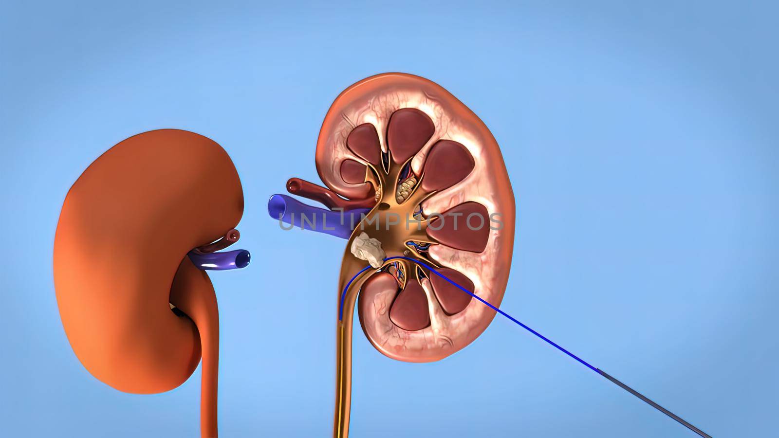 Kidney stones are small pebbles of salt and mineral in the urine. 3Dillustration