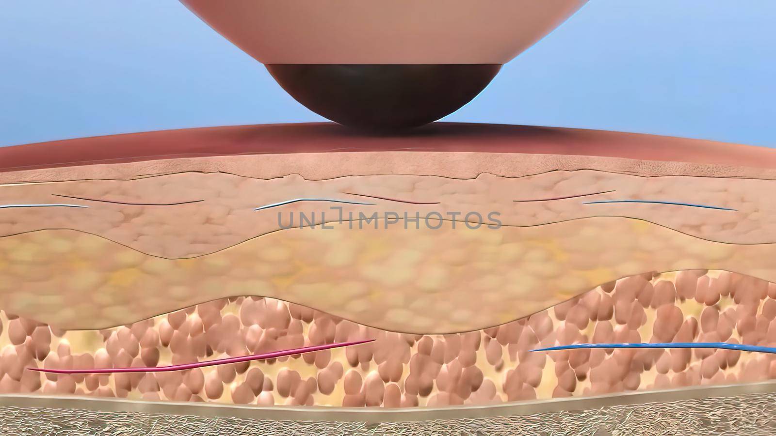 3D illustration simulation of fractional Laser Skin Resurfacing surgery procedure with two consecutive treatments