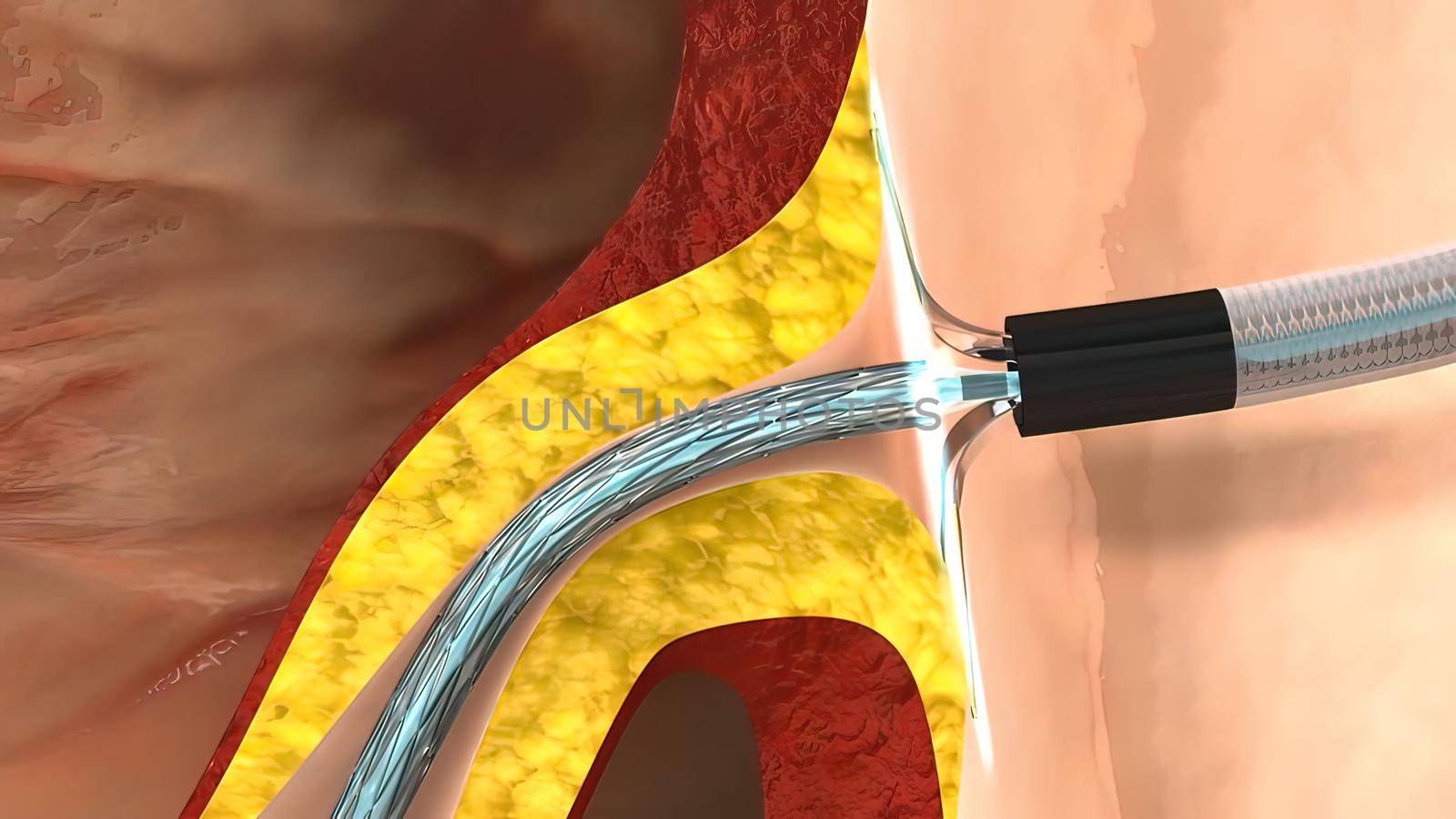 coronary angiography procedures 3D illustration