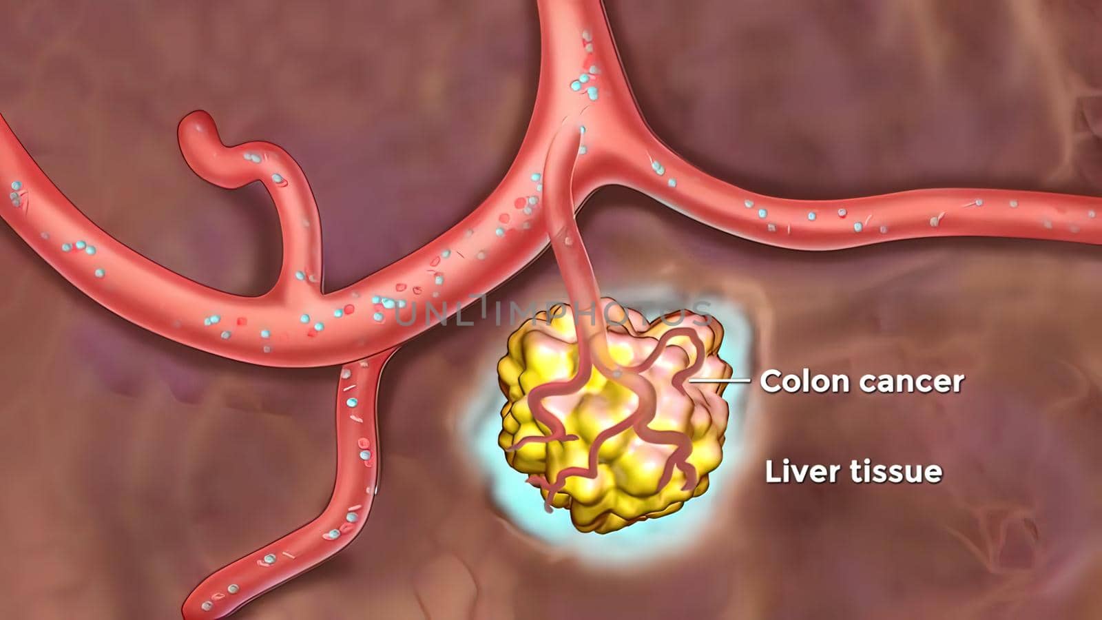 Metastasis for cancer that spreads to a different part of the body from where it started. 3D illustration