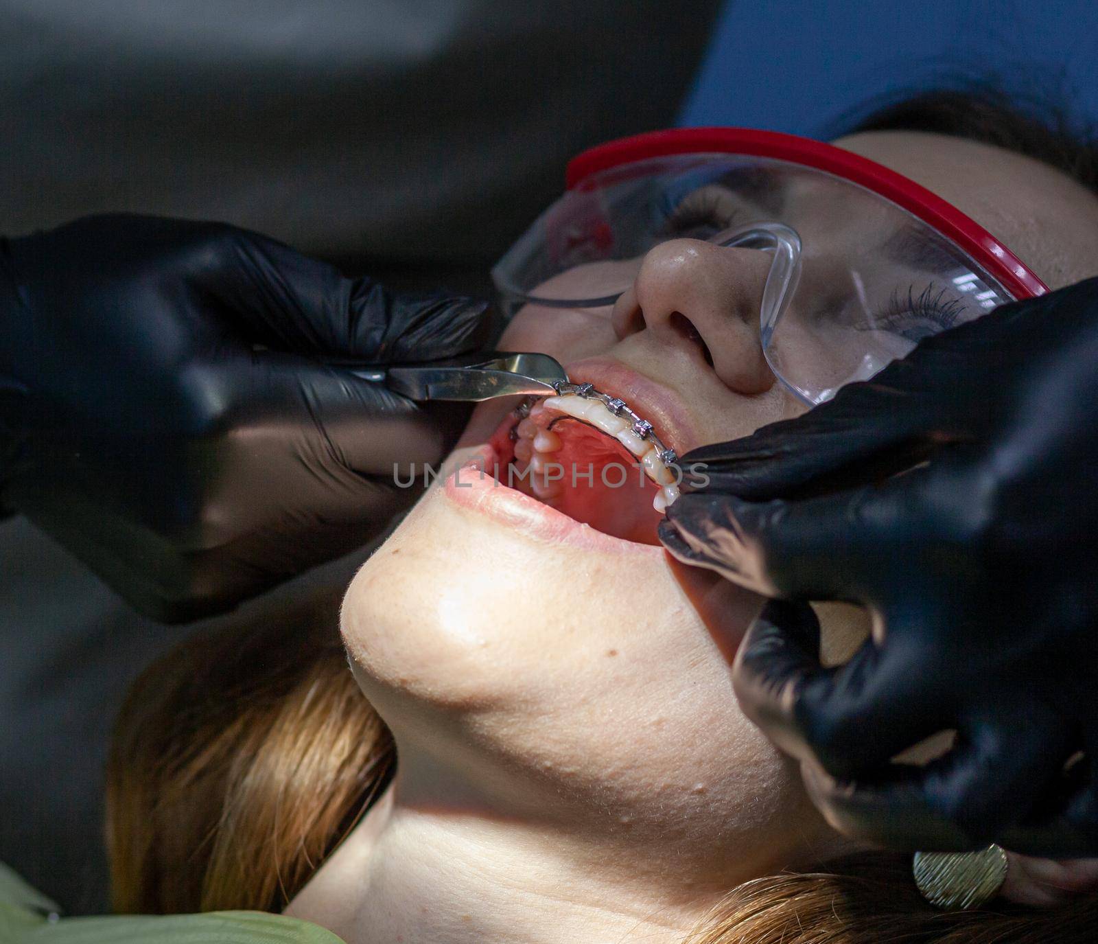 The process of removing braces. A beautiful woman in protective glasses in a dental chair during the procedure of removing braces from teeth. Dentist and assistant working.