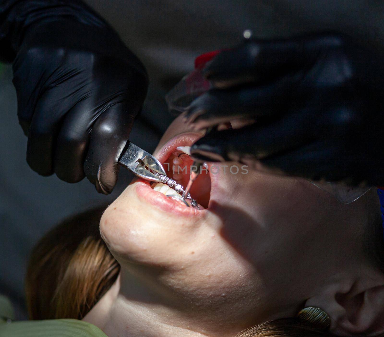 The process of removing braces. A beautiful woman in protective glasses in a dental chair during the procedure of removing braces from teeth. Dentist and assistant working.