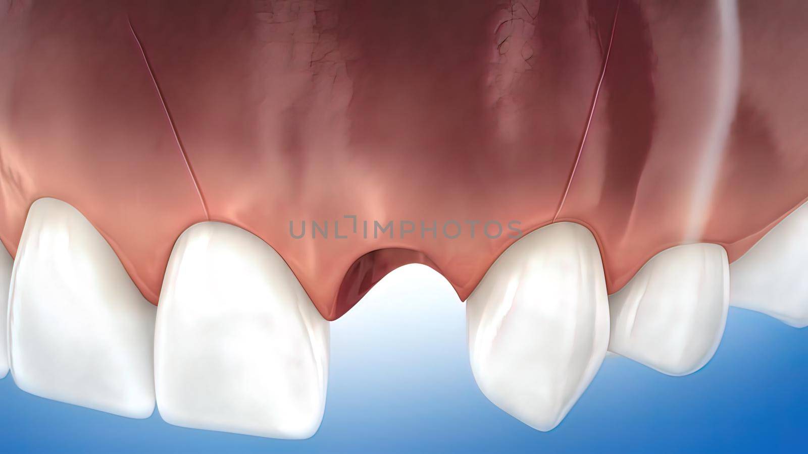 Dental implant surgery. A dental implant is a metal post that replaces the root portion of a missing tooth. 3D illustration