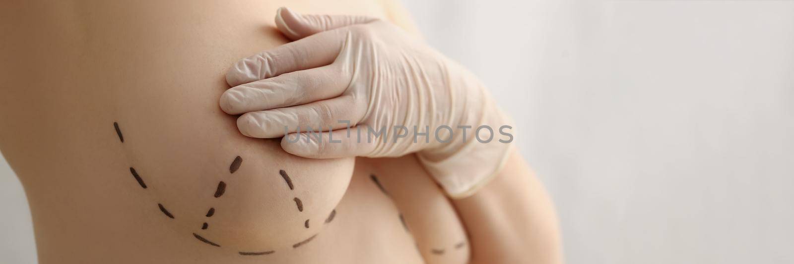Close-up of female with marking on boobs for cosmetic surgery procedure, ready for bigger breasts, final step before surgery. Modern medicine, beauty, plastic, cosmetic surgery concept