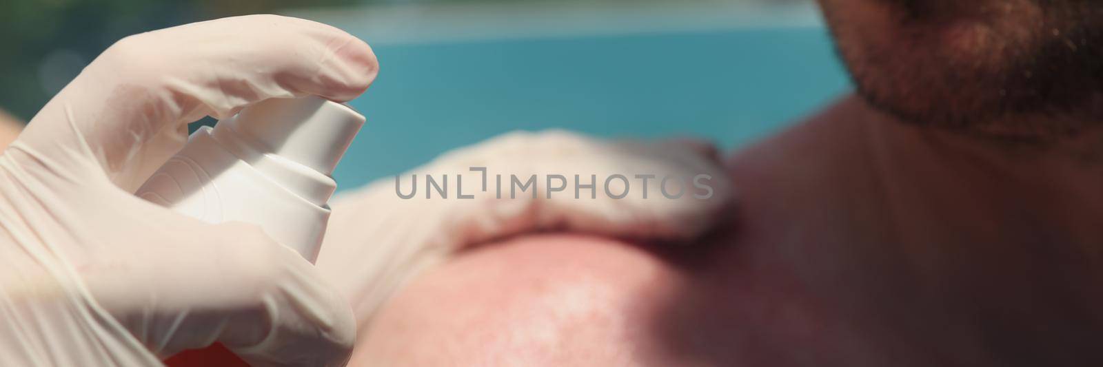 Close-up of person hand holding cosmetic bottle with sunscreen lotion. Woman spraying protective burn cream after sunburn on male shoulder. Skincare and sunburn concept