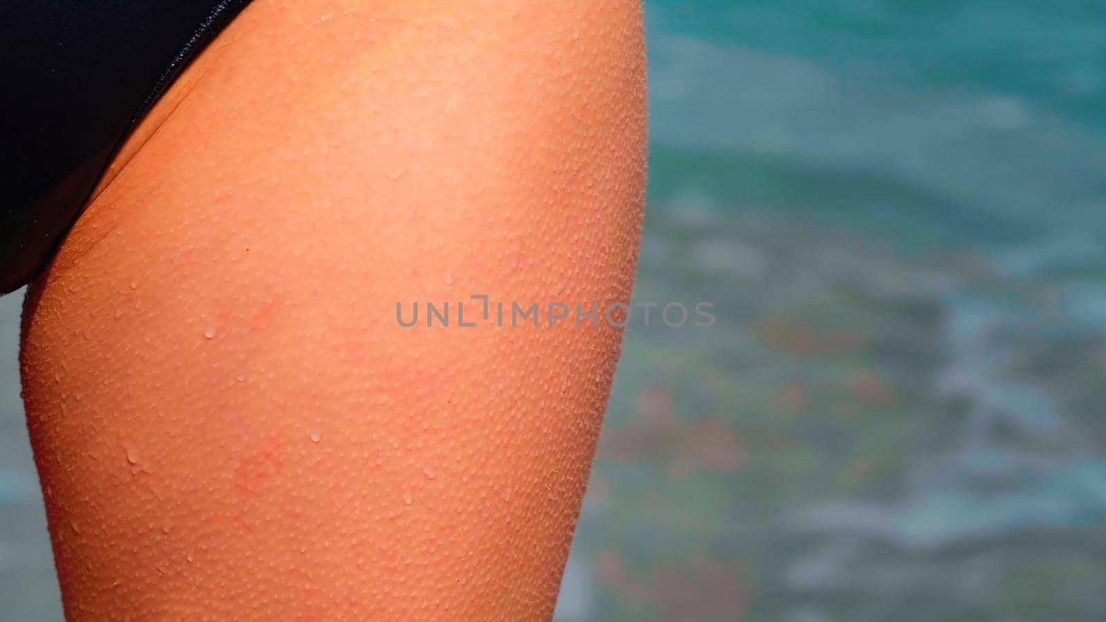 Goosebumps on a woman thighs. by RecCameraStock