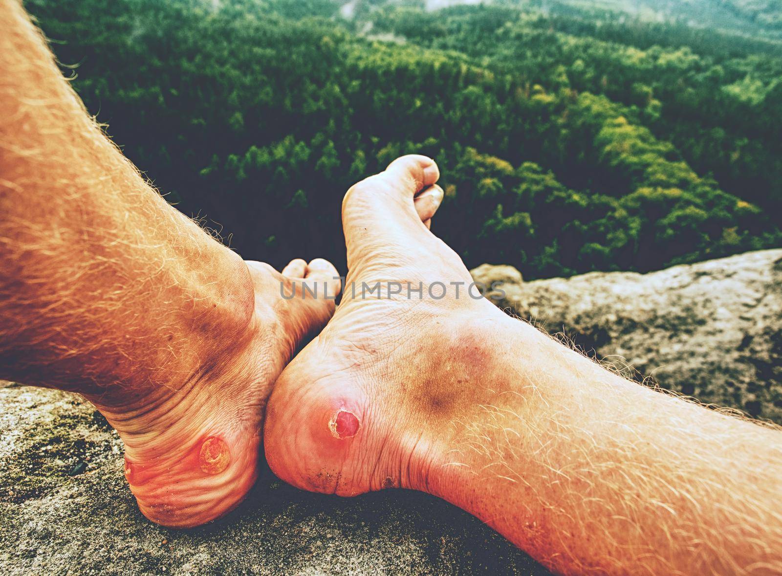 Man hiker sweaty legs with horrible painful callus resting on mountain peak. Misty rocky landscape  with a valley at background