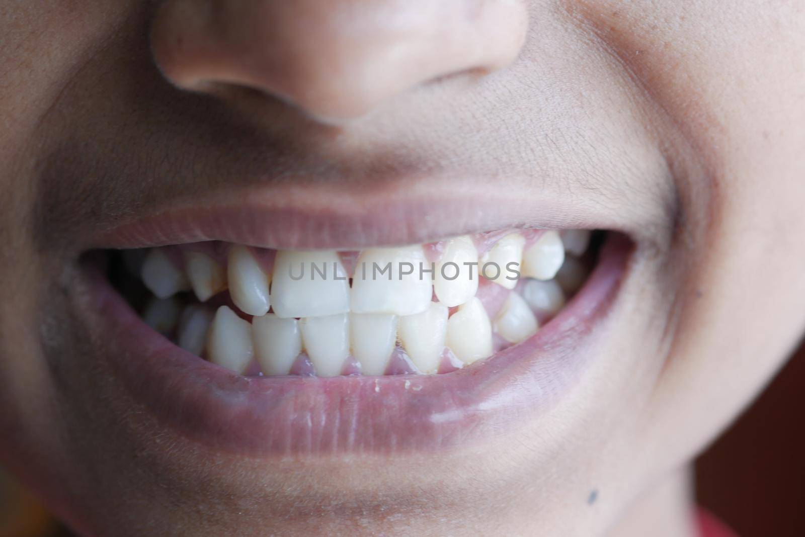 teenage boy smiling with healthy white teeth