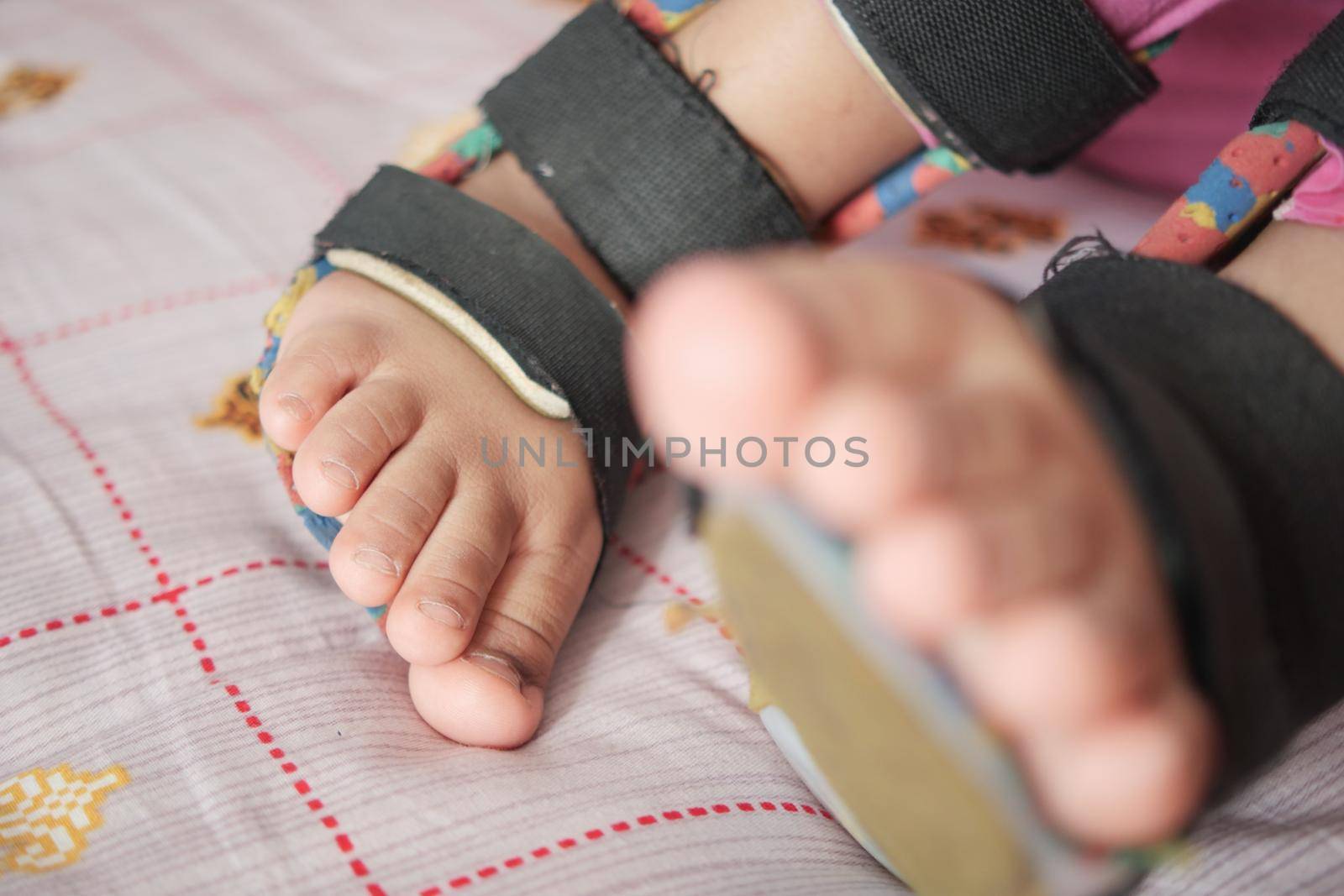 Child cerebral palsy disability, legs orthosis