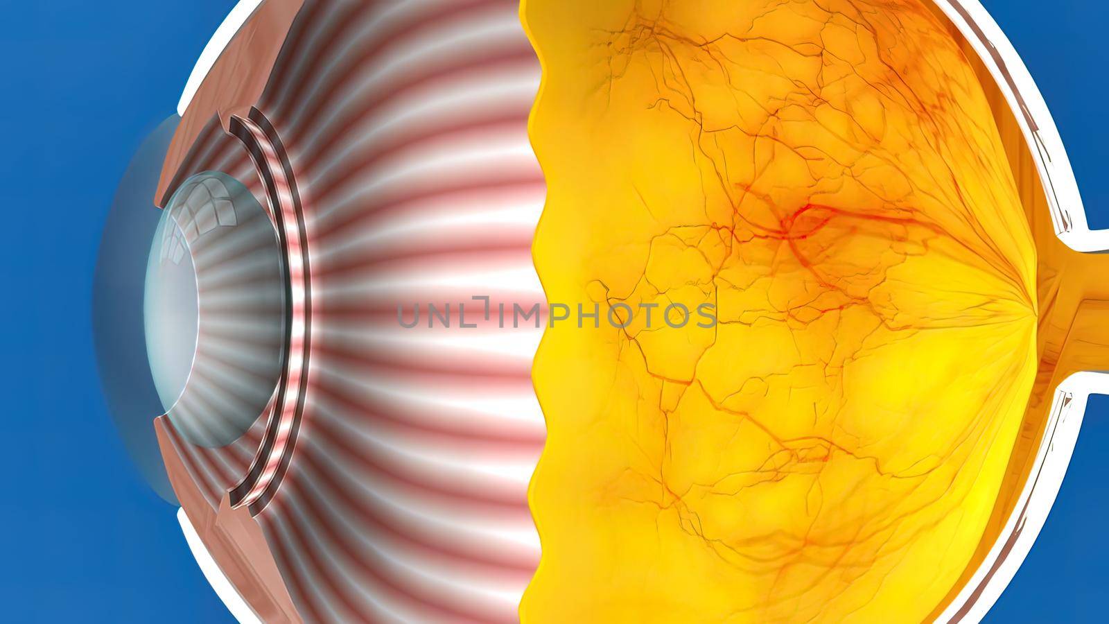 Low-tension or normal-pressure glaucoma. In normal-tension glaucoma the optic nerve is damaged even though the pressure in the eye is not very high. 3d illustration