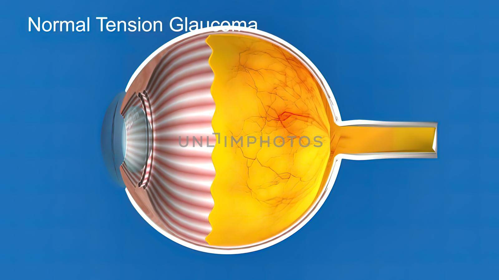 3D Medical Animated Normal Tension Glaucoma on Blue Background by creativepic
