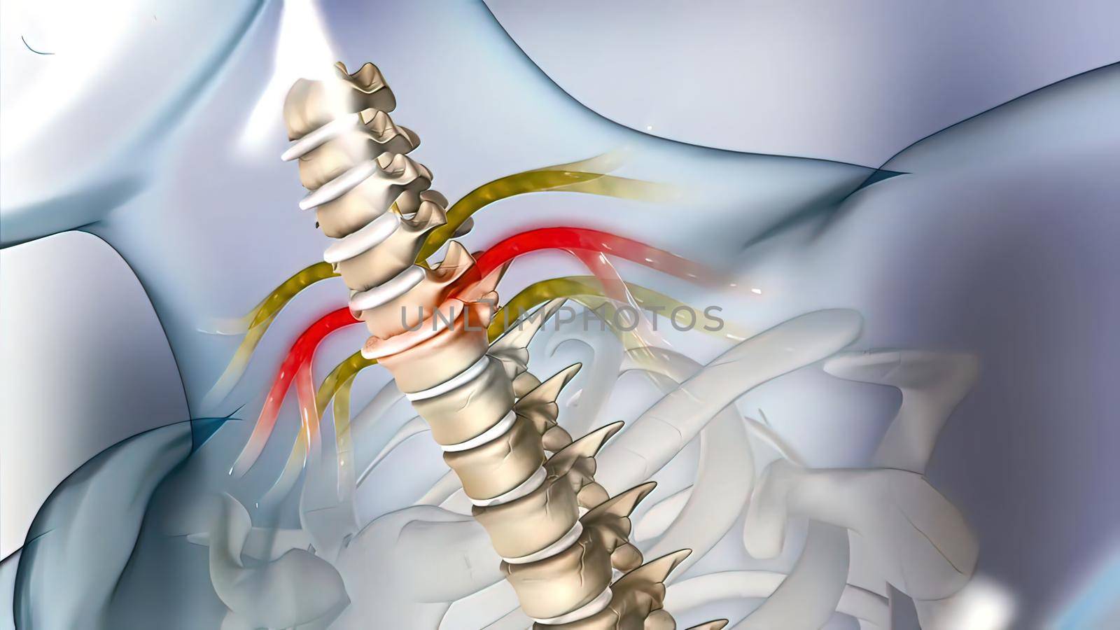nerve compression of discs 3d medical by creativepic