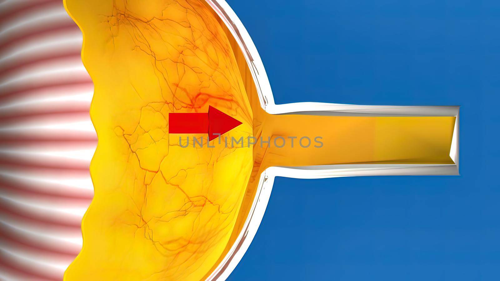 Low-tension or normal-pressure glaucoma. In normal-tension glaucoma the optic nerve is damaged even though the pressure in the eye is not very high. 3d illustration