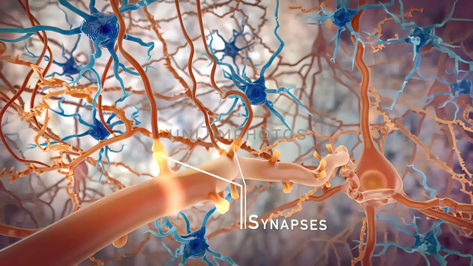 Neurons With Amyloid Plaques, by creativepic