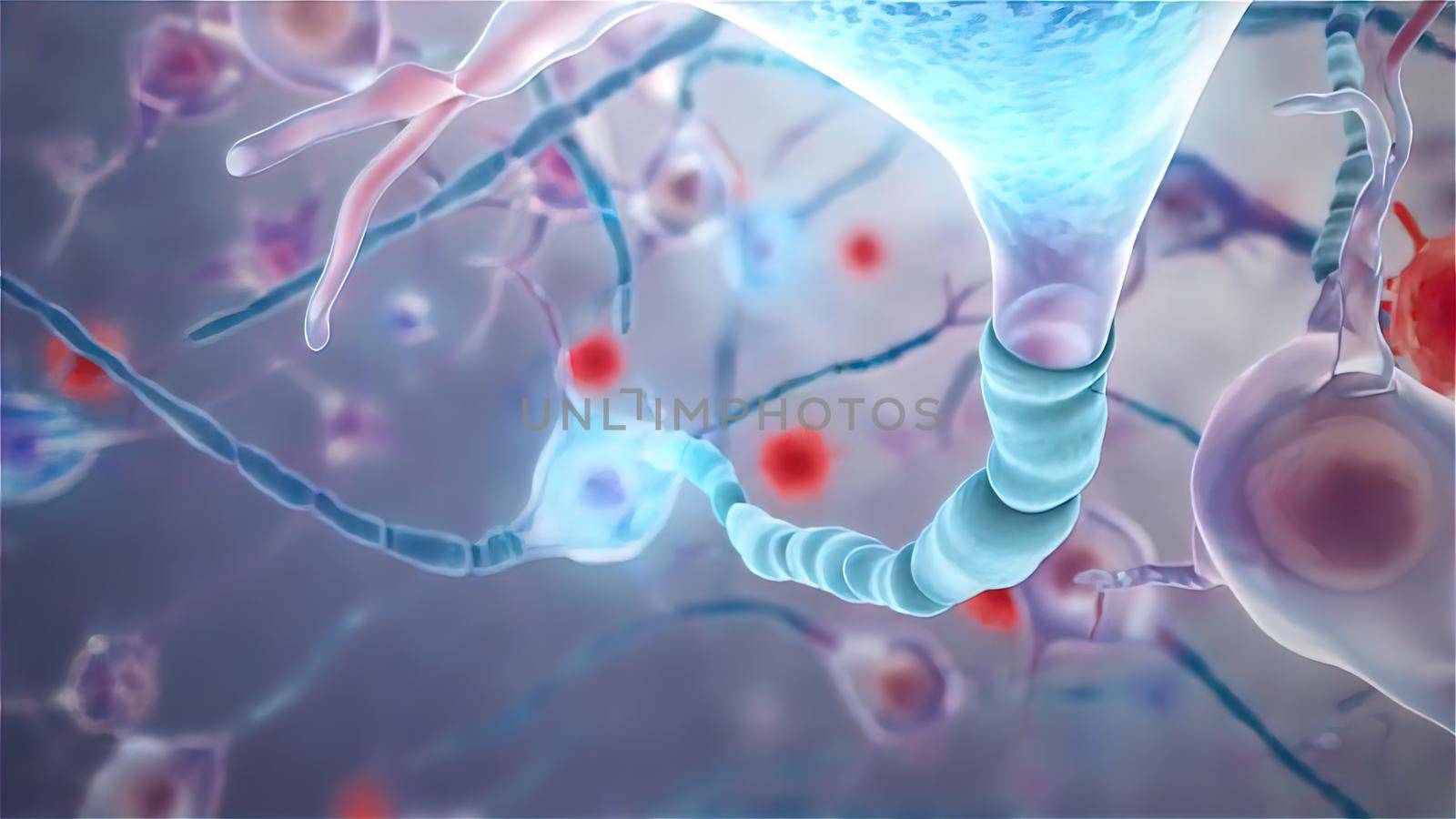 Nerve Cell Destructionin Multiple Sclerosis by creativepic