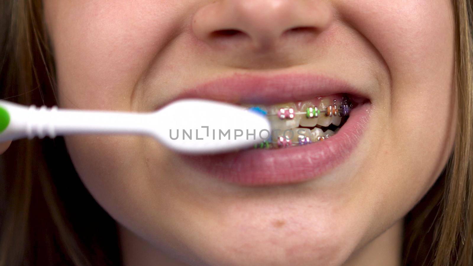 Girl with braces brush her teeth with a toothbrush closeup. A girl with colored braces on her teeth keeps her teeth clean. by Puzankov