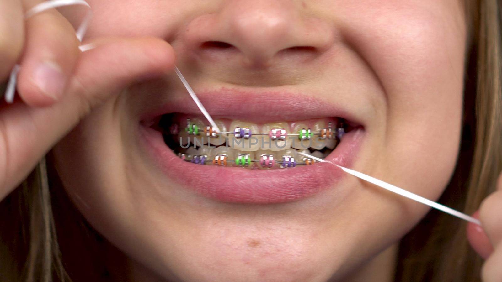 Girl with braces brushing your teeth with dental floss closeup. A girl with colored braces on her teeth keeps her teeth clean. 4k