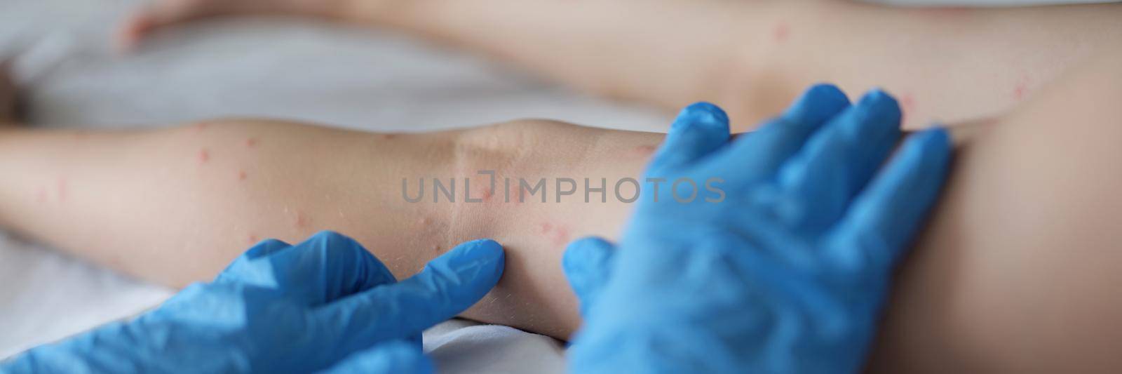 Family doctor examining red rash on legs of child in clinic by kuprevich