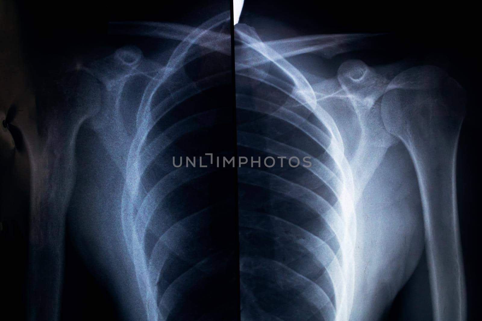 X-ray of the shoulder from both sides close up