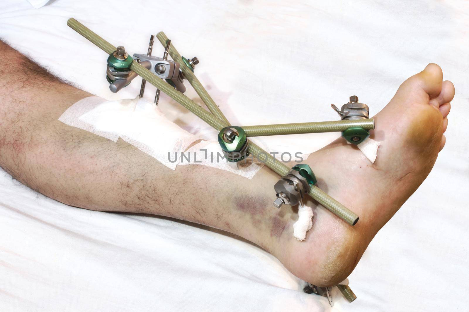 A man's leg with orthopaedic metal rods forming a fixed brace
