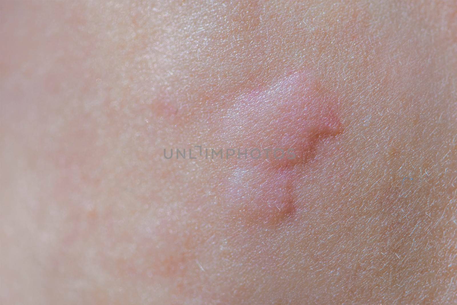 Urticaria on the skin. Red spots of an allergic reaction on the skin of a child. Urticaria symptoms close up by SERSOL