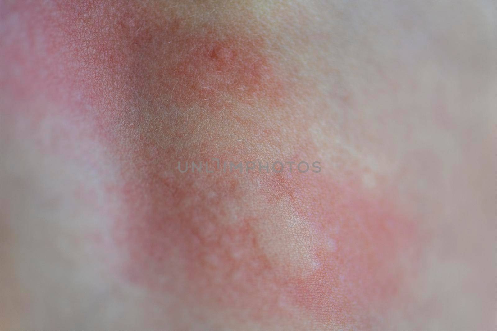 Urticaria on the skin. Red spots of an allergic reaction on the skin of a child. Urticaria symptoms close up by SERSOL