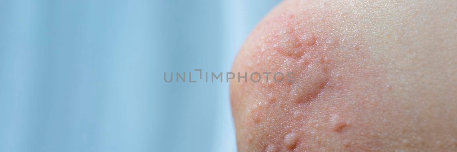 Urticaria on the skin. Red spots of an allergic reaction on the skin of a child. Urticaria symptoms close up by SERSOL